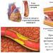 Kod odroczonego zawału mięśnia sercowego 10